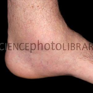 Gout In Ankle - Exactly How I Overcame Gout Through Atkins Diet