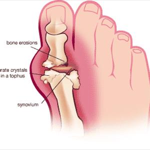Big Toe Gout - Treatment Of Gout By Homeopathic Means