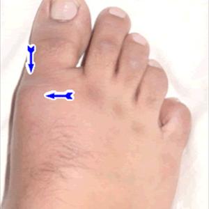 Gout And Fever 