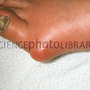 Gout Diet Foods - Relief For Gout Pain