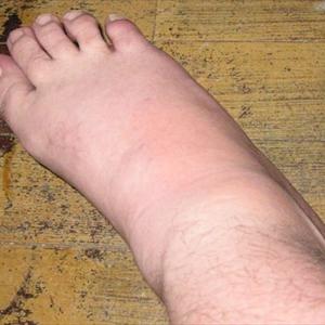 False Gout - Discussion About Key Perform Of Vit C In Alleviation Of Gout