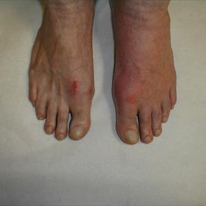 Polyarticular Gout - Food Restrictions For Gout - What Can I Eat?