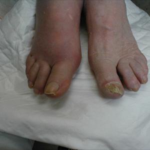 Pics Of Gout - Celery Seeds: An Effective Gout Remedy At Very First Stage