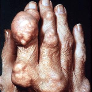 Gout Diet Handout - Is Grapefruit Bad For Gout Or Can I Eat It?