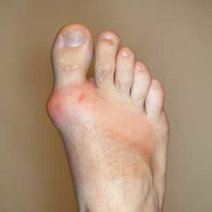 Anti Gout Recipes - How Should I Help Out Myself Not To Have A Gout Invasion?