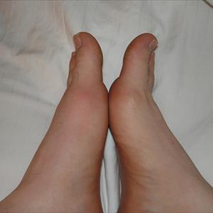 Gout And Fever - Benefits Of Combining Gout Treatments And Diet For A Dramatic Reduction Of Gout Symptoms