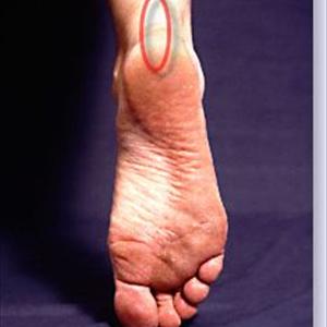 Gout Big Toe - Treatment Of Gout By Homeopathic Means