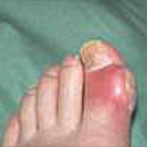 Gout Good Foods - Get Fit To Fight Gout