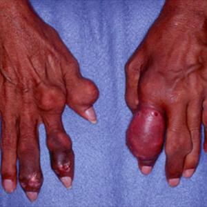 Gout Exercise - Cure For Gout