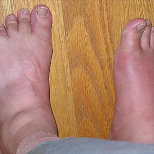 Toe Pain Gout - How To Manage Gout By Using Particular Diet?