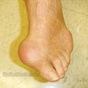 Gout - Facts About Gout Home Treatment Solution