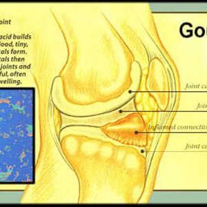 Diet For Gout - What You Need To Know About Gout Medication
