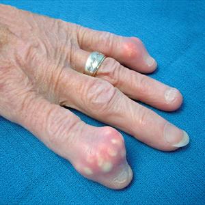 Relieve Gout Pain - What Is The Best Way To Control Gout Problem?