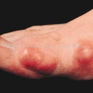 Gout Natural Remedy - Out With Gout Remedy Report
