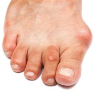 Colchicine For Gout - Gout Inside The Ankle- Uncomplicated Option To Get Rid Of The Pains