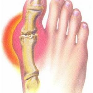 Shellfish And Gout - Natural Gout Remedies - Cure Gout In 2 Hours Or Less